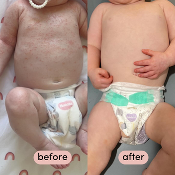 Before and after comparison of a child's skin condition wearing a nappy. One side bub has red rash with bumps for before and after has no red rash or bumps.